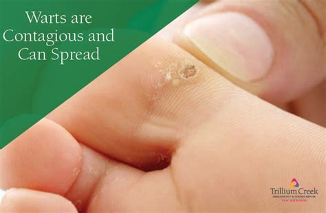 Are Warts Contagious