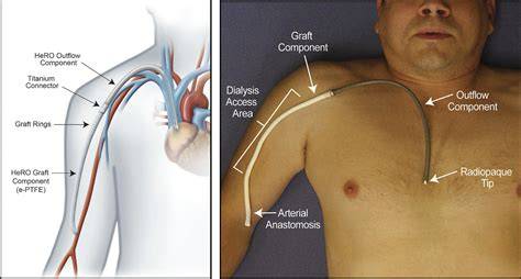 Arm Catheter For Dialysis