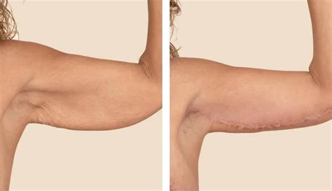 Arm Fat Removal