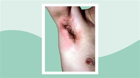 Armpit Sores Painful