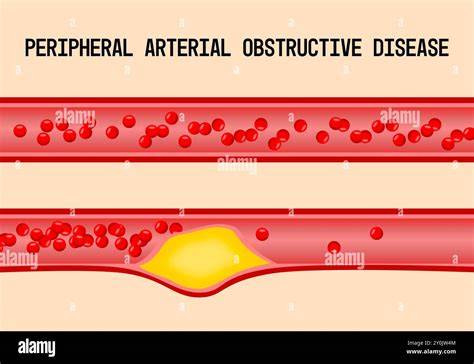 Arterial Occlusive Disease