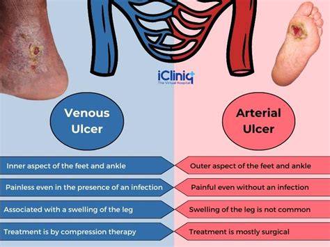 Arterial Vs Venous Stasis Ulcer