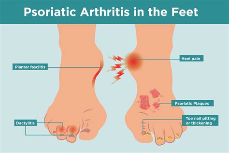 Arthritis And Foot