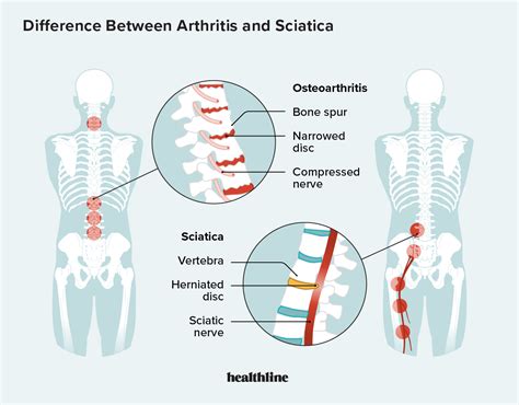 Arthritis In Back