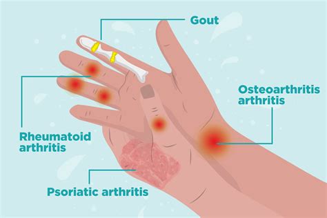 Arthritis In The Hands