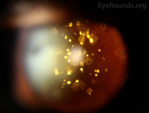 Asteroid Hyalosis Does It Affect Vision