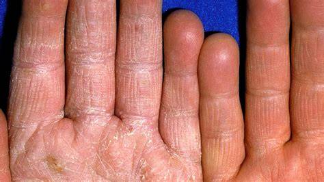 Athletes Foot On Hands