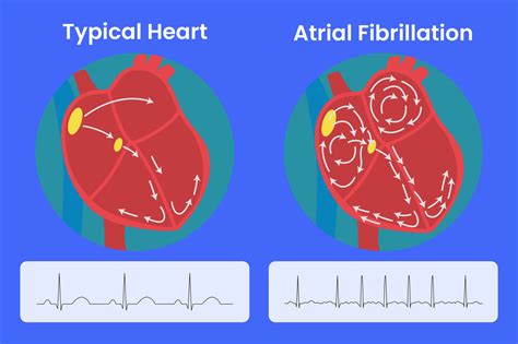 Atrial Fibrillation Lifespan