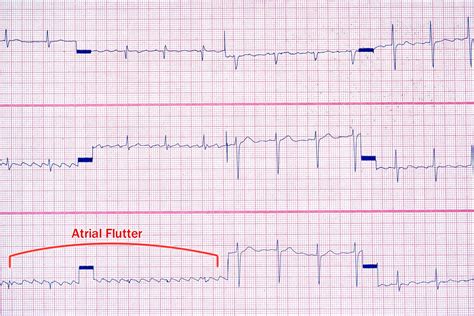 Atrial Flutter Ecg