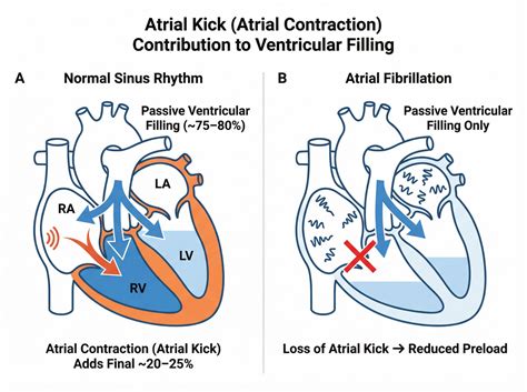 Atrial Kick