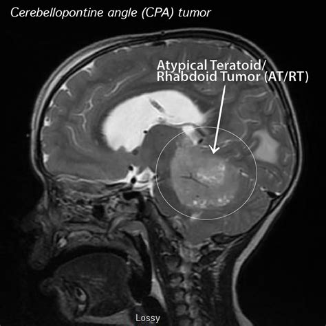Atypical Teratoid Tumor