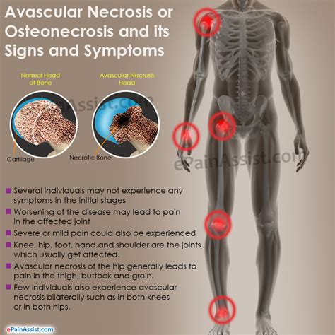 Avascular Necrosis Symptoms