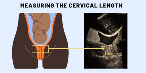 Average Cervix Length