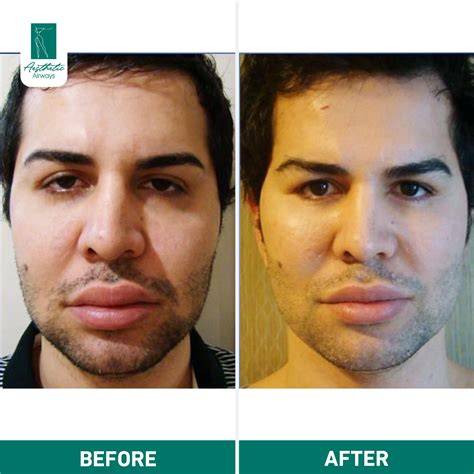 Baby Face Surgery