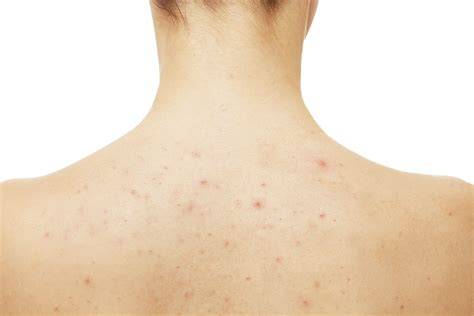 Back Acne Dermatology