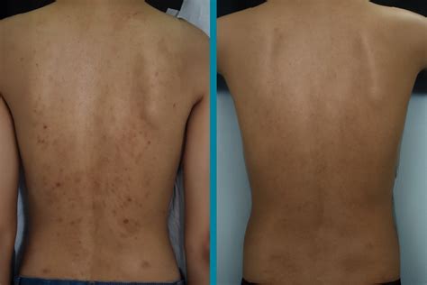 Back Acne Scars