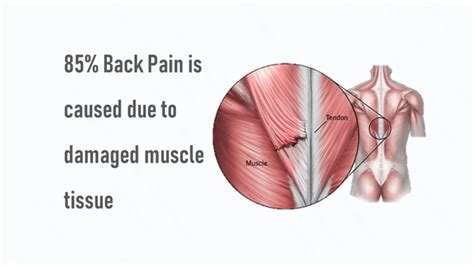 Back Muscle Strain Symptoms