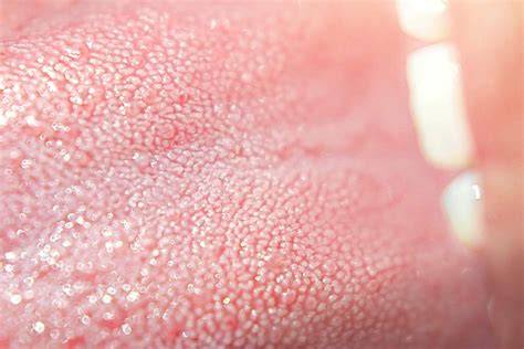 Back Of Tongue Raised Bumps