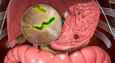 Bacteria En El Estomago