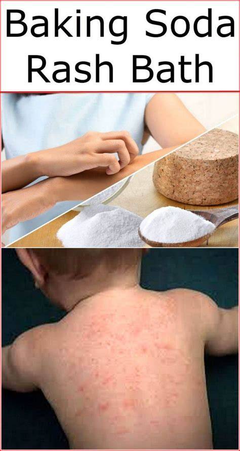 Baking Soda Bath For Thrush