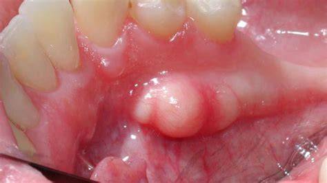 Ball In Gums Mouth