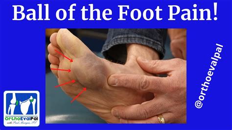 Ball Of Foot Pain