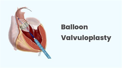 Balloon Aortic Valvuloplasty