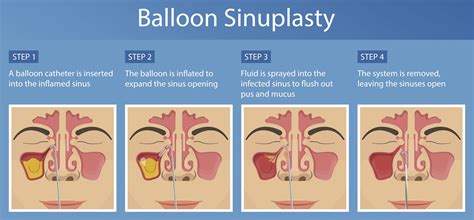 Balloon Sinus Dilation