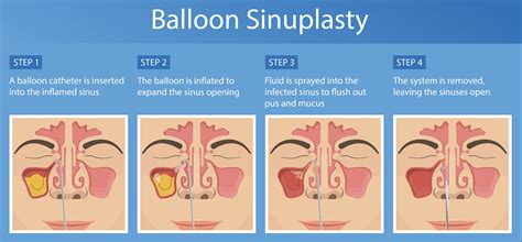 Balloon Sinusitis Surgery