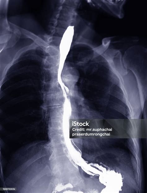 Barium Swallow Exam
