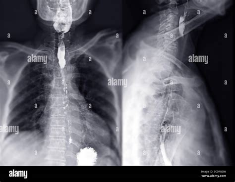 Barium Swallow Test