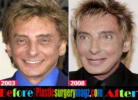 Barry Manilow Face Surgery
