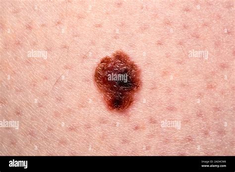 Basal Cell Carcinoma Malignant Melanoma