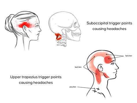 Base Of Skull Hurts