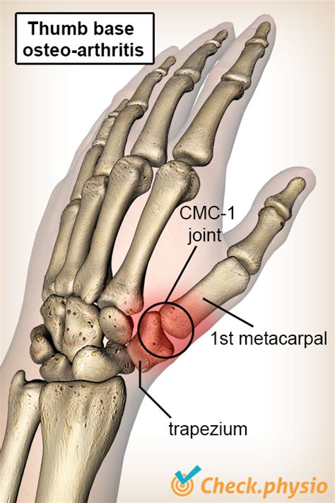 Base Of Thumb Pain