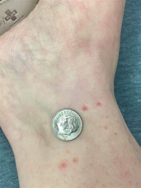 Bat Bites Marks