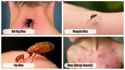 Bed Bug Rashes