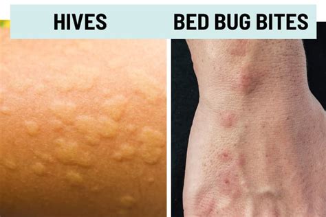 Bed Bug Stress Hives