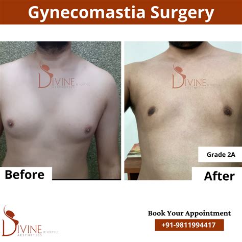 Before And After Gynaecomastia Surgery