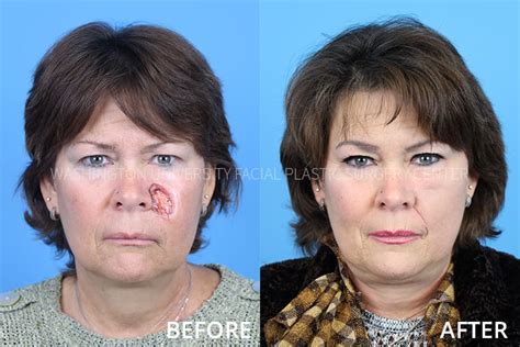 Before And After Plastic Surgery Face