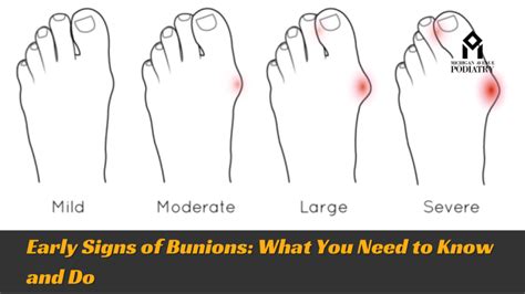 Beginning Signs Of A Bunion