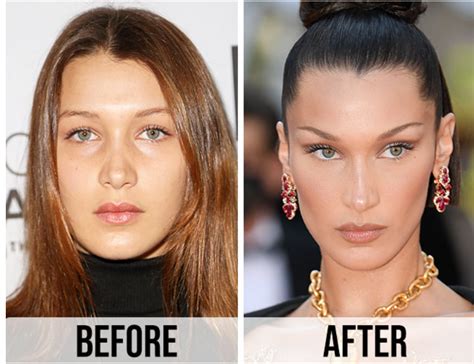 Bella Hadid Before Face Surgery