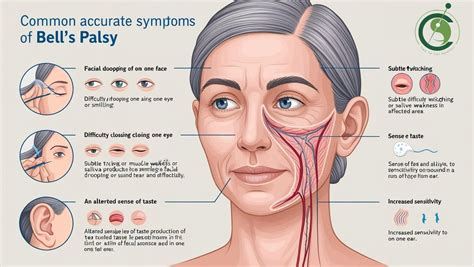 Bell's Palsy Lyme Disease Symptoms