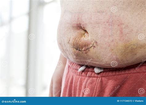 Belly Button Umbilical