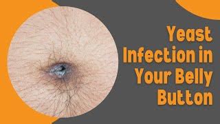 Belly Button Yeast Infection