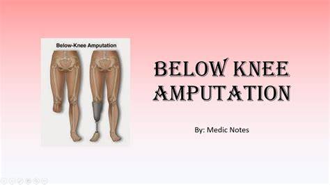 Below Knee Amputation