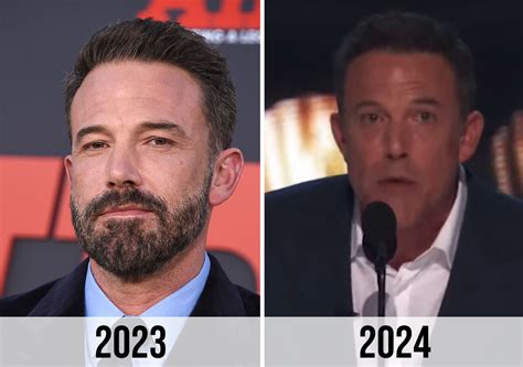 Ben Affleck Face Surgery