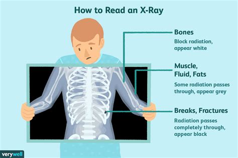 Benefits Of X Rays