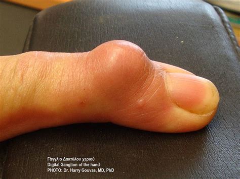 Bible Cyst Pop