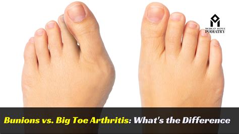 Big Toe Arthritis